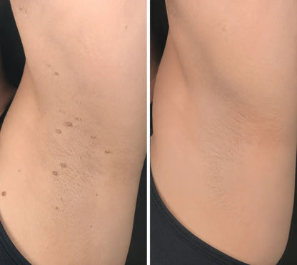 ✨Evroya®2-in-1 Microneedle & Hydrocolloid Patch🍀